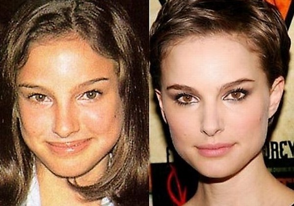 before and after plastic surgery (14)