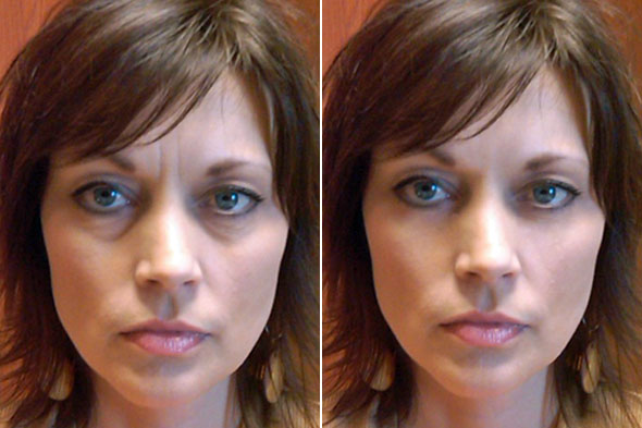 under-eye-plastic-surgery-before-and-after-53