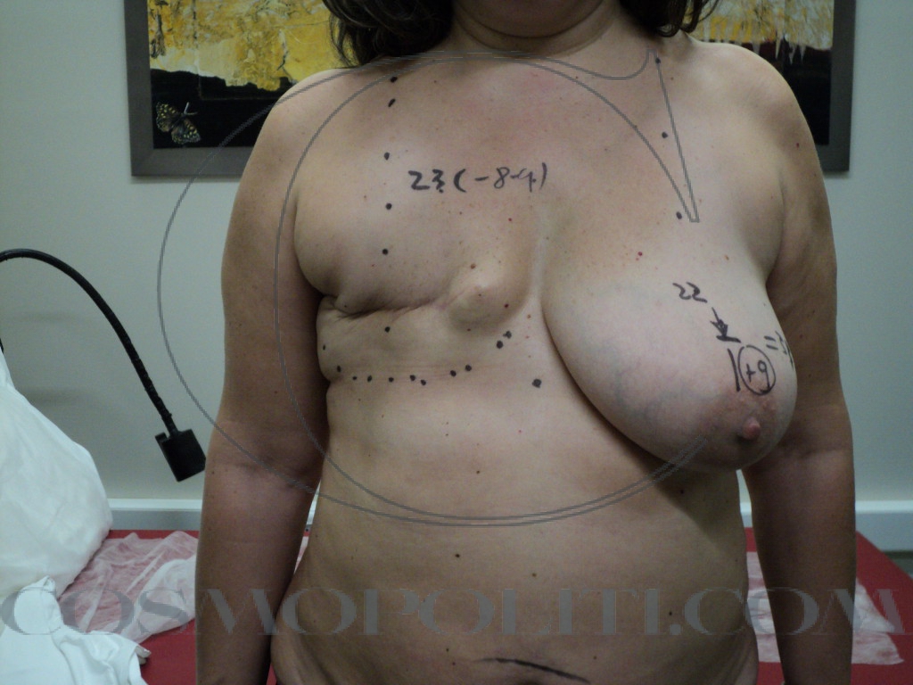 mastectomy no recon (1)