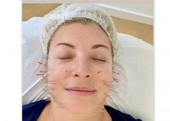 Είναι ο κοσμητικός βελονισμός το νέο μποτόξ;