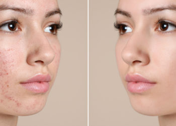 Πώς αντιμετωπίζουμε την εφηβική ακμή